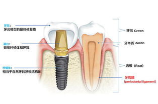 田林路种植牙能用多久,7大因素影响种植牙寿命 