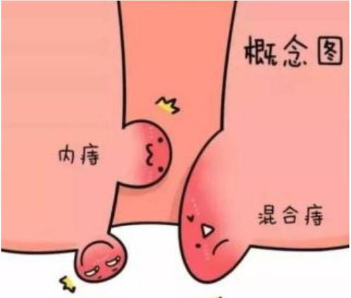外痔疮肉球的最佳治疗方法,青岛京北肛肠医院让你看看古人是如何做的