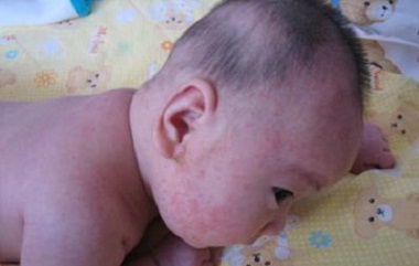 宝宝脸上湿疹痒得很,如何治疗小儿湿疹 治疗婴儿湿疹6步骤