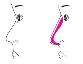 假体隆鼻都有哪些危害呢 三大后遗症你要早知道