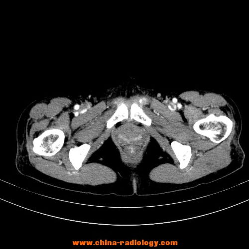 影联网 示教读片 典型左侧卵巢巨大粘液囊腺瘤 